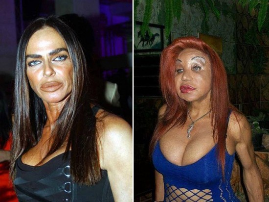 Plastic Surgery Gone Wrong (17 Photos) FunCage