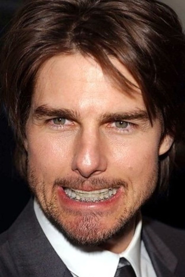 Celebrities-Wearing-Braces-003
