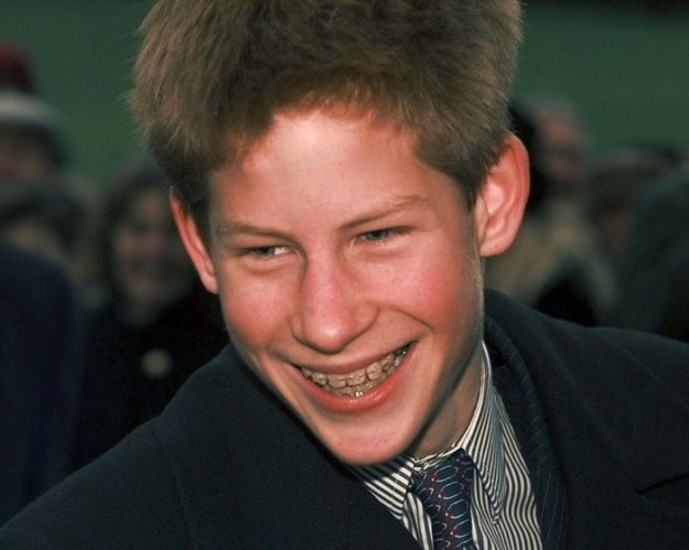 Celebrities-Wearing-Braces-017