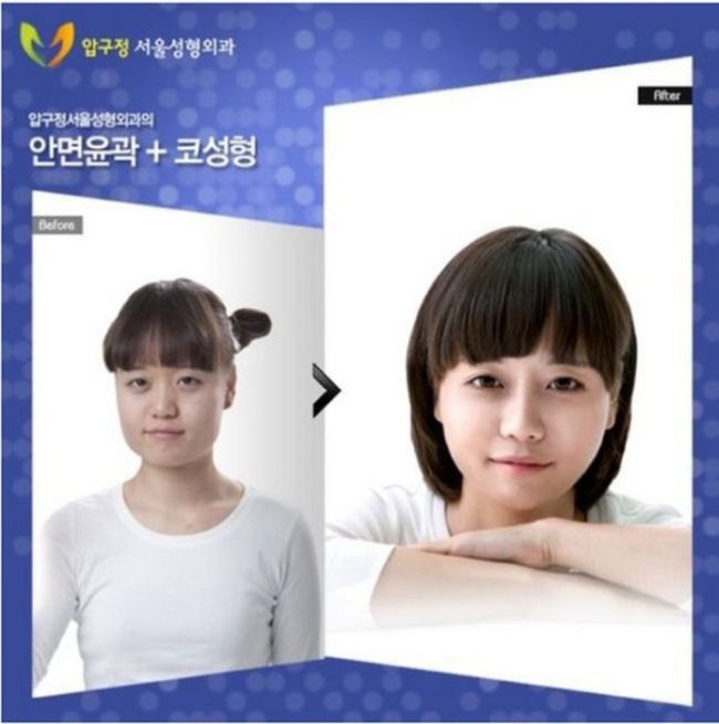 Before and After Plastic Surgery 003