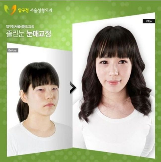 Before and After Plastic Surgery 004