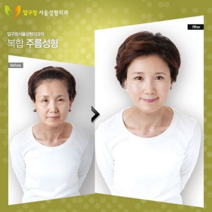 Before and After Plastic Surgery 006