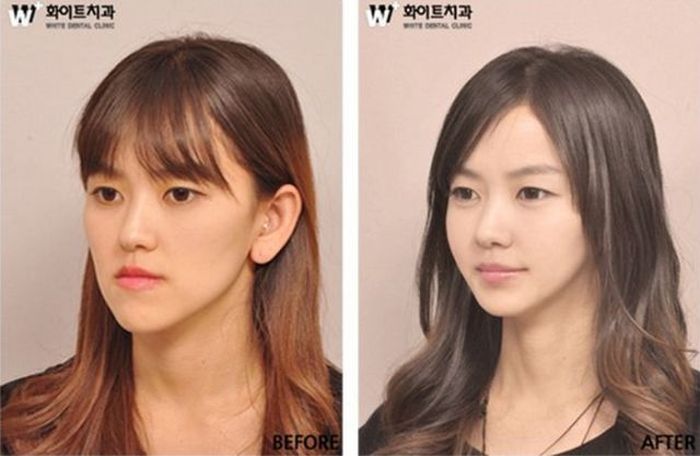 Before and After Plastic Surgery 008