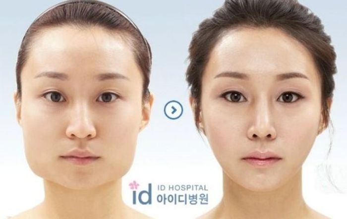 Before and After Plastic Surgery 013