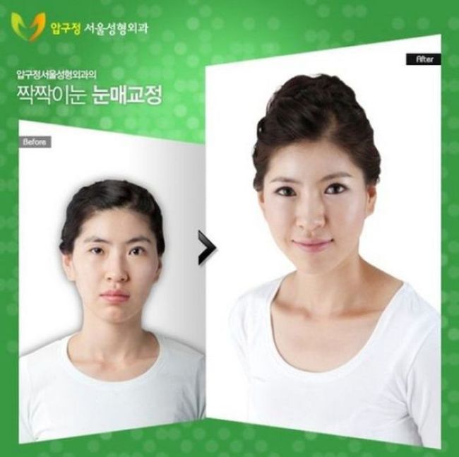 Before and After Plastic Surgery 015