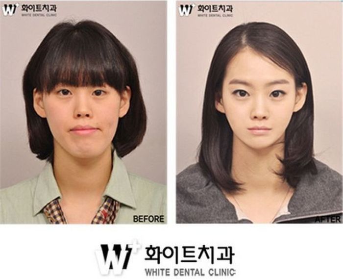 Before and After Plastic Surgery 019