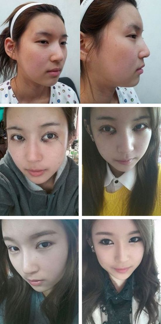 Before and After Plastic Surgery 021