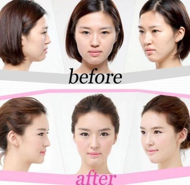 Before and After Plastic Surgery 022