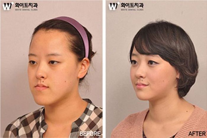Before and After Plastic Surgery 023