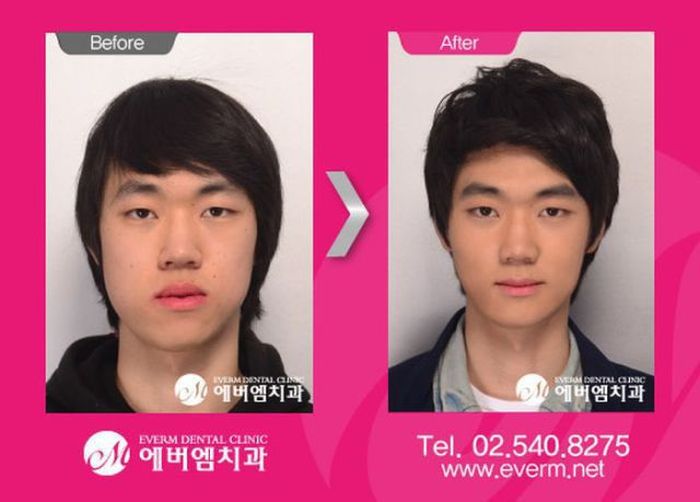 Before and After Plastic Surgery 024