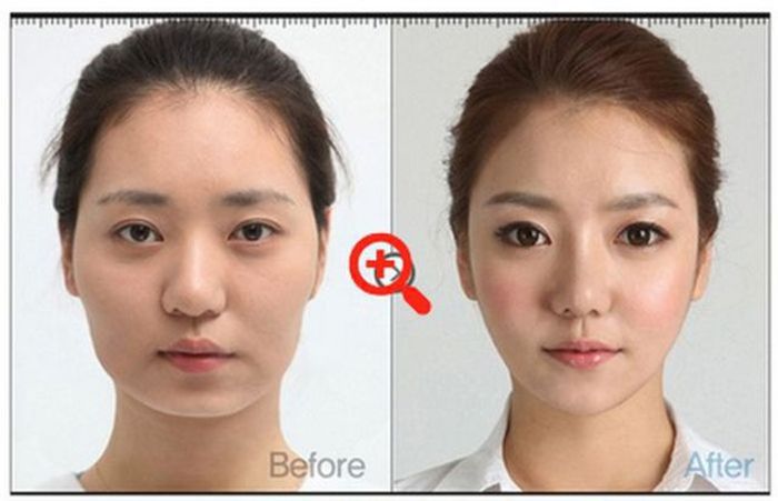 Before and After Plastic Surgery 025
