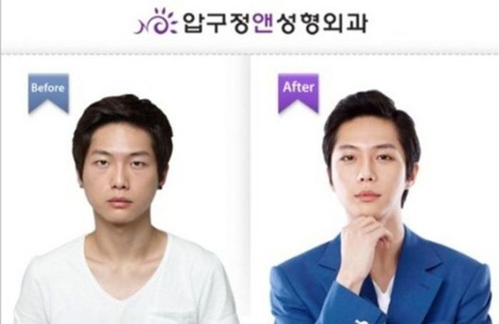 Before and After Plastic Surgery 026