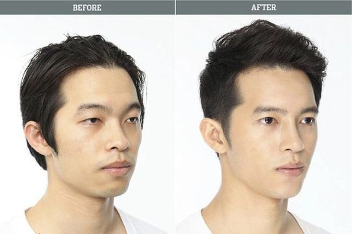 Before and After Plastic Surgery 027