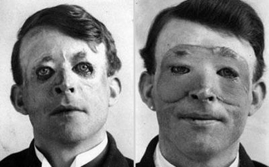 Walter Yeo, one of the first to undergo an advanced plastic surgery and a skin transplant, 1917