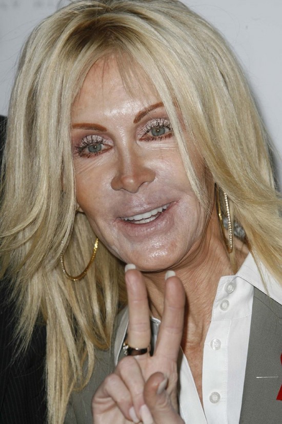 Plastic Surgery Gone Wrong 010